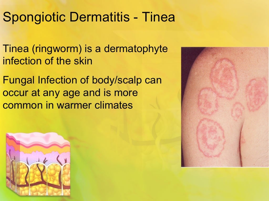 Spongiotic dermatitis tinea