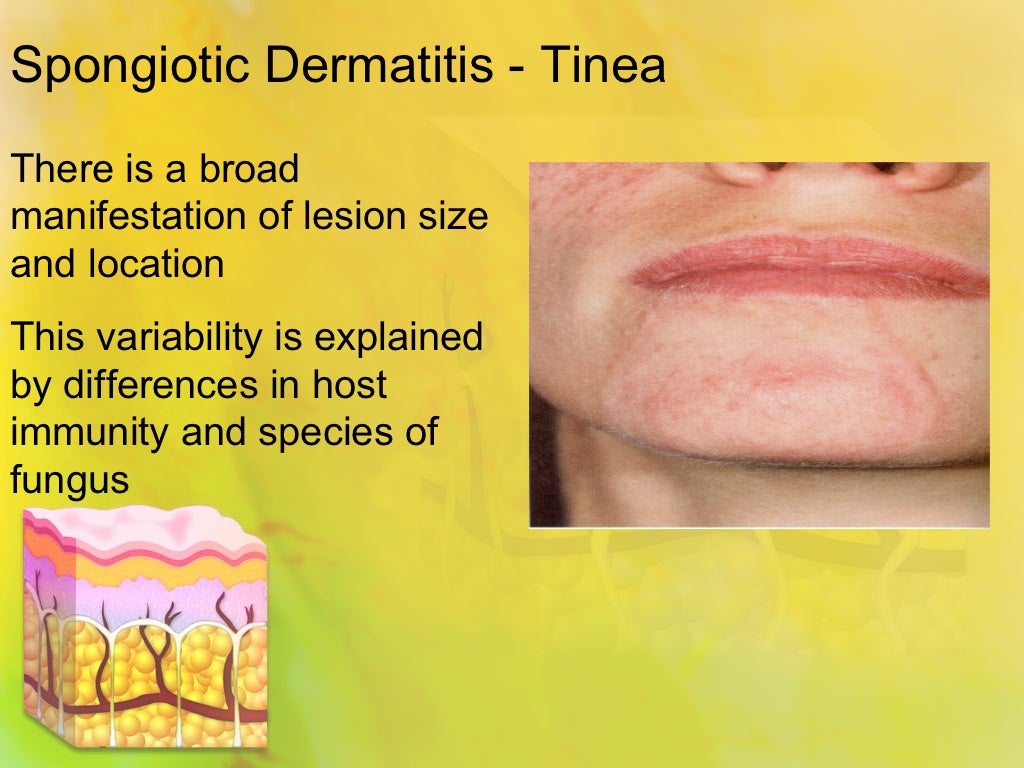 Spongiotic dermatitis tinea