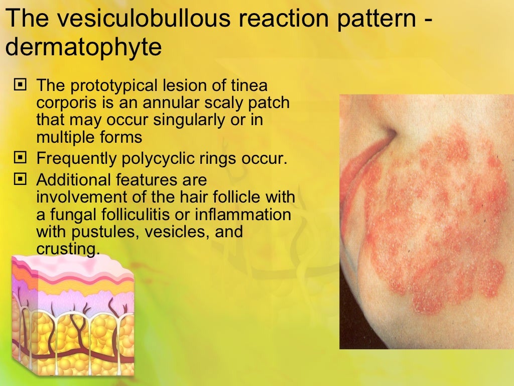 Spongiotic dermatitis tinea