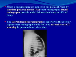When a pneumothorax is suspected but not confirmed by  standard posteroanterior (PA)  chest radiographs,  lateral   radiographs  provide added information in up to 14% of cases.  The  lateral decubitus radiograph  is superior to the erect or supine chest radiograph and is felt to be  as sensitive as CT scanning  in pneumothorax detection. 