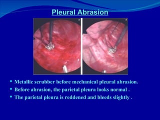 Pleural Abrasion Metallic scrubber before mechanical pleural abrasion.  Before abrasion, the parietal pleura looks normal . The parietal pleura is reddened and bleeds slightly . 