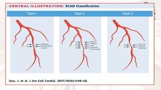 Scad Subtypes Spontaneous coronary artery dissection in women | PPTX