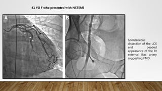 Non-Astherosclerotic Spontaneous Coronary Dissection | PPTX