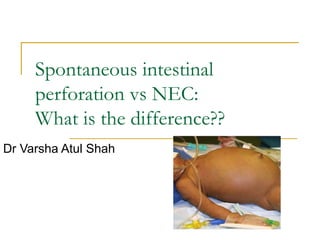 Spontaneous intestinal
     perforation vs NEC:
     What is the difference??
Dr Varsha Atul Shah
 