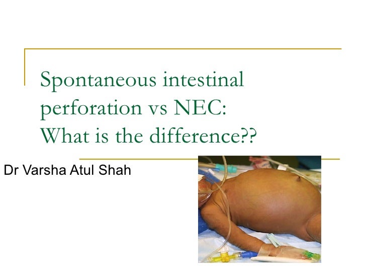 Spontaneous intestinal perforation vs nec