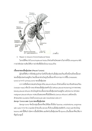 ภาพที่ 8
   4. Repair or closure of bronchopleural fistula
        ในกรณีทพบวามี bronchopleural fistula เกิดรวมดวยโดยเฉพาะในรายทีเ่ ปน empyema หลัง
               ี่
การผาตัดปอด จะตองไดรับการผาตัดเพือปดบริเวณ fistula ดวย
                                     ่

เนื้องอกของเยื่อหุมปอด (Pleural Tumors)
         ผูปวยที่ไดรับการวินิจฉัยและรักษาโรคที่เกี่ยวของกับเยือหุมปอดเกือบครึ่งหนึงจะมีโรคเนื้องอก
                                                                  ่                    ่
ของเยื่อหุมปอดรวมอยูดวย โดยเนื้องอกสวนใหญเปนเนืองอกทีกระจายมาจากที่อื่น (metastatic
                                                          ้        ่
tumor) มากกวา primary tumor ของเยื่อหุมปอด  
         อาการหรือสิ่งตรวจพบสวนใหญมาดวย pleural effusion อีกสวนหนึ่งอาจมาดวยลักษณะกอน
(nodular mass) หรือ มีการหนาตัวของเยื่อหุมปอดทั่วๆไป (diffuse pleural thickening) หากตรวจพบ
bloody pleural effusion สวนใหญมักพบเนื้องอกของเยือหุมปอดรวมอยูดวย แตประมาณ 50%ของ
                                                             ่
malignant pleural effusion จะพบเปนของเหลวที่ไมมเี ลือดปน (serous effusion) แตยังคงเปน
ลักษณะของ exudative โดยมี lymphocyte และ mesothelial cells มาก
Benign Tumors และ Cysts ของเยื่อหุมปอด
         Benign tumor จัดเปนกลุมเนื้องอกทีพบไดนอย ซึงไดแก lipomas, endothelioma, angiomas
                                               ่              ่
และ cysts จากภาพ x-rayปอด มักพบเปน density ที่บริเวณเยื่อหุมปอดติดกับ chest wall สวนใหญ
lesions เหลานี้มีตนกําเนิดจากเนื้อเยื่อใตตอ และติดกับเยื่อหุมปอด ซึ่ง lipoma เปนเนื้องอกที่พบไดมาก
ที่สุดในกลุมนี้
 