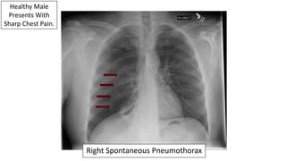 Healthy Male
Presents With
Sharp Chest Pain.
Right Spontaneous Pneumothorax
 