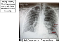 Young, Healthy
Male Experiences
Acute Left-Sided
Chest Pain While
Running.
Left Spontaneous Pneumothorax
 