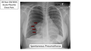 EMGuideWire's Radiology Reading Room: Spontaneous Pneumothorax