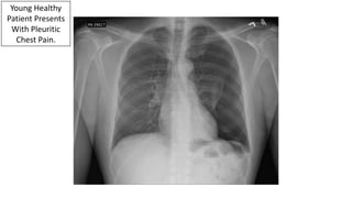 Young Healthy
Patient Presents
With Pleuritic
Chest Pain.
 
