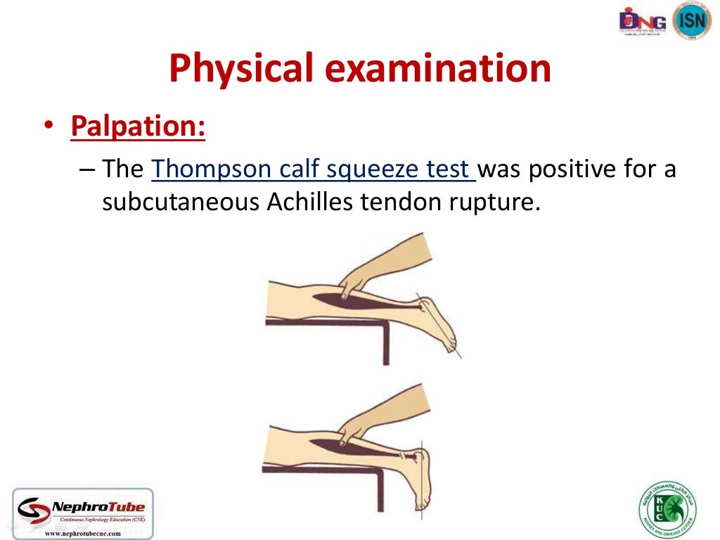 End Stage Renal Disease Patient With Spontaneous Tendo-Achilles Rupture ...