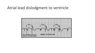 Atrial lead dislodgment to ventricle
 