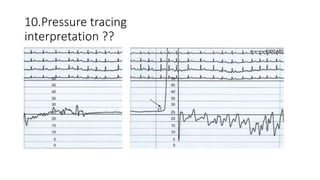 10.Pressure tracing
interpretation ??
 