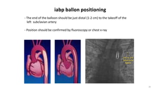 28
- The end of the balloon should be just distal (1-2 cm) to the takeoff of the
left subclavian artery
- Position should be confirmed by fluoroscopy or chest x-ray
iabp ballon positioning
 