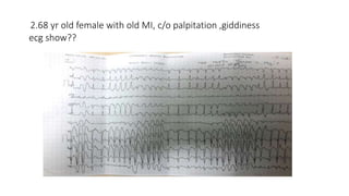 2.68 yr old female with old MI, c/o palpitation ,giddiness
ecg show??
 