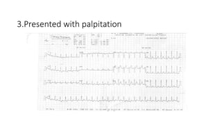 3.Presented with palpitation
 