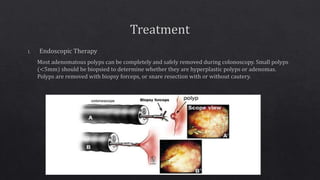 Sporadic colon cancer