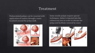 Sporadic colon cancer