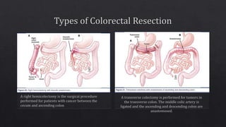Sporadic colon cancer