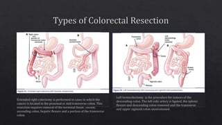 Sporadic colon cancer