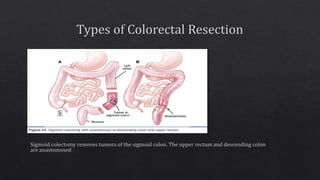 Sporadic colon cancer