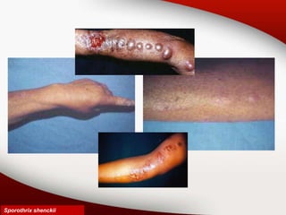Sporothrix shenckii
 