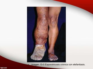 • Imagen 15-5 Esporotricosis crónica con elefantiasis.
 