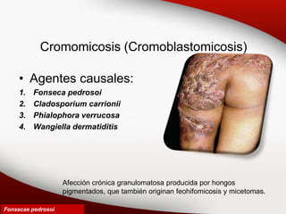 Cromomicosis (Cromoblastomicosis)
• Agentes causales:
1. Fonseca pedrosoi
2. Cladosporium carrionii
3. Phialophora verrucosa
4. Wangiella dermatiditis
Fonsecae pedrosoi
Afección crónica granulomatosa producida por hongos
pigmentados, que también originan feohifomicosis y micetomas.
 