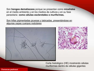 Fonsecae pedrosoi
Son hongos dematiaceos porque se presentan como miceliales
en el medio ambiente y en los medios de cultivos y en su fase
parasitaria como células esclerotales o muriformes.
Son hifas pigmentadas gruesas y tabicadas, presentándose en
algunas cepas cuerpos nodulares
Corte histológico (HE) mostrando células
muriformes dentro de células gigantes
 