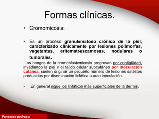 Formas clínicas.
• Cromomicosis:
• Es un proceso granulomatoso crónico de la piel,
caracterizado clínicamente por lesiones polimorfas,
vegetantes, eritematoescamosas, nodulares o
tumorales.
.Los hongos de la cromoblastomicosis progresan por contigüidad,
invadiendo la piel y el tejido celular subcutáneo por inoculación
cutánea, suelen originar un pequeño número de lesiones satélites
producidas por diseminación linfática o auto inoculación.
• En general sigue los linfáticos más superficiales de la dermis.
Fonsecae pedrosoi
 