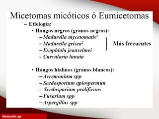 III. Sedosporium apiospermun
Madurella sp
 