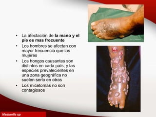 • La afectación de la mano y el
píe es mas frecuente
• Los hombres se afectan con
mayor frecuencia que las
mujeres
• Los hongos causantes son
distintos en cada país, y las
especies prevalecientes en
una zona geográfica no
suelen serlo en otras
• Los micetomas no son
contagiosos
Madurella sp
 