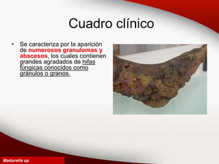 Cuadro clínico
• Se caracteriza por la aparición
de numerosos granulomas y
abscesos, los cuales contienen
grandes agradados de hifas
fúngicas conocidos como
gránulos o granos.
Madurella sp
 