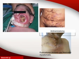 Madurella sp
Actinomicetoma
Eumicetoma causado por Madurella
mycetomatis.
 