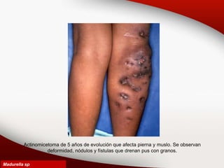 Actinomicetoma de 5 años de evolución que afecta pierna y muslo. Se observan
deformidad, nódulos y fístulas que drenan pus con granos.
Madurella sp
 