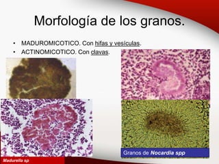 Morfología de los granos.
• MADUROMICOTICO. Con hifas y vesículas.
• ACTINOMICOTICO. Con clavas.
Madurella sp
Granos de Nocardia spp
 