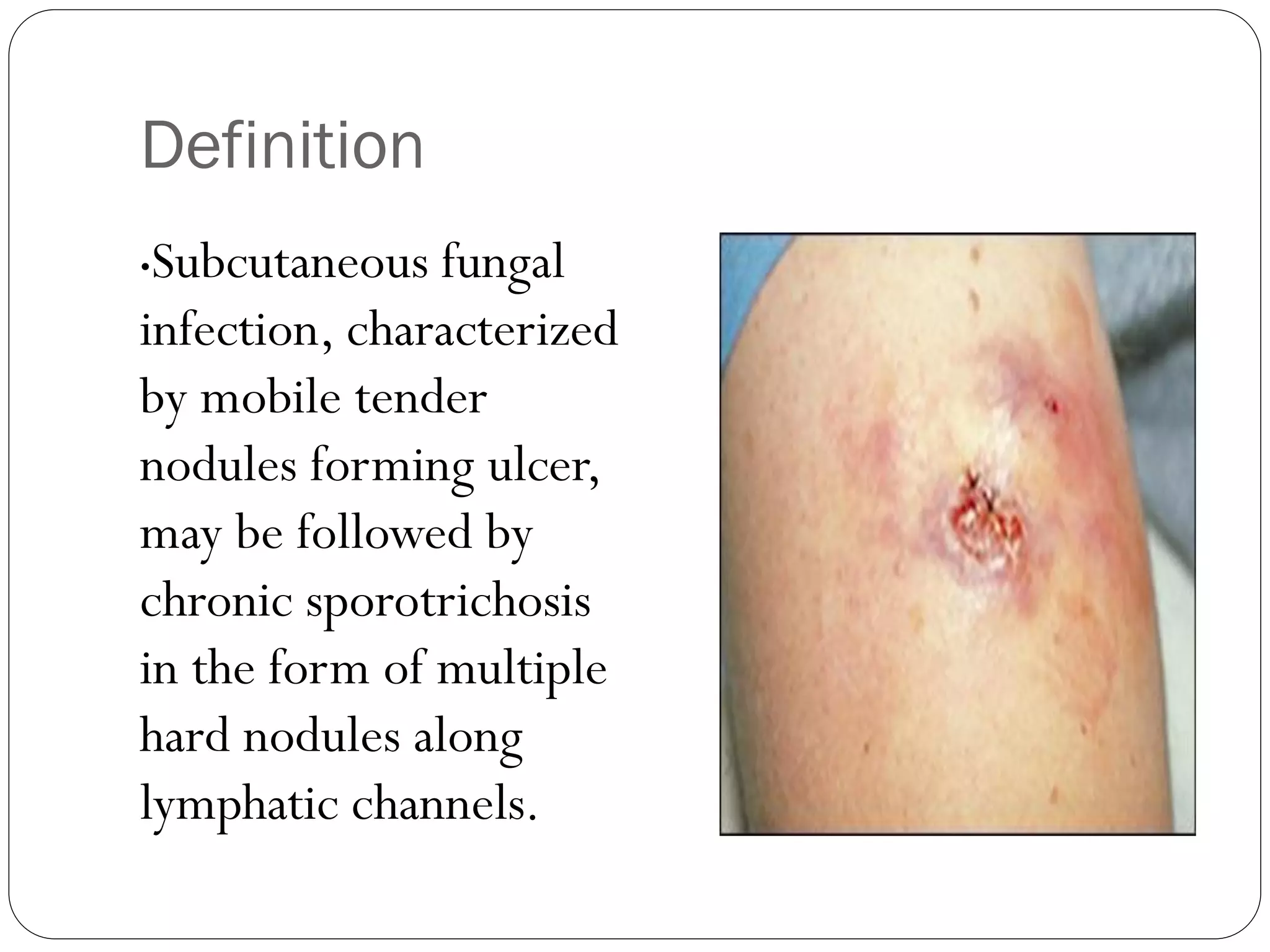 Definition
•Subcutaneous fungal
infection, characterized
by mobile tender
nodules forming ulcer,
may be followed by
chronic sporotrichosis
in the form of multiple
hard nodules along
lymphatic channels.
 