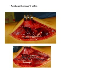 Achillessehnennaht  offen 