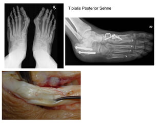 Tibialis Posterior   Sehne 