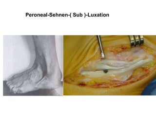 Peroneal-Sehnen-( Sub )-Luxation 