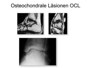 Osteochondrale Läsionen OCL 