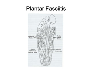 Plantar Fasciitis 