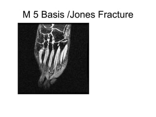 M 5 Basis /Jones Fracture 