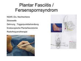 Plantar Fasciitis / Fersenspornsyndrom NSAR, Eis, Nachtschiene  Stosswelle Dehnung , Triggerpunktbehandlung Endoscopische ...