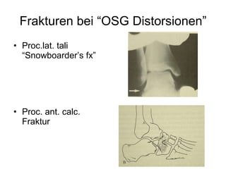 Frakturen bei “OSG Distorsionen” <ul><li>Proc.lat. tali “Snowboarder’s fx” </li></ul><ul><li>Proc. ant. calc. Fraktur </li...