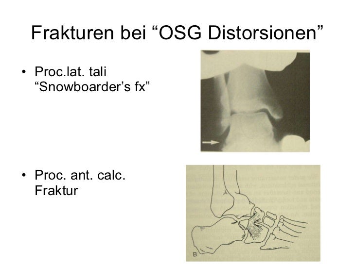Osg Distorsion Wie Lange Krank de.slideshare.net