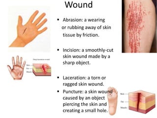 Wound
 Abrasion: a wearing
or rubbing away of skin
tissue by friction.
 Incision: a smoothly-cut
skin wound made by a
sharp object.
 Laceration: a torn or
ragged skin wound.
 Puncture: a skin wound
caused by an object
piercing the skin and
creating a small hole.
 