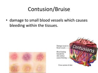 Contusion/Bruise
• damage to small blood vessels which causes
bleeding within the tissues.
 