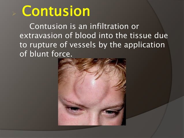 Sports Injuries PPT