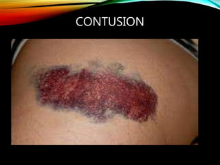 sports injuries.ppt